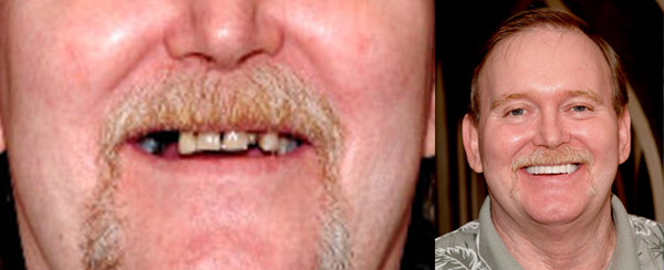 Smile Makeovers TeethToday Dental Implant Center