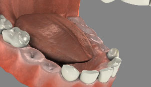 Mouth model with missing teeth