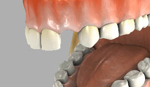 Mouth model with a missing tooth