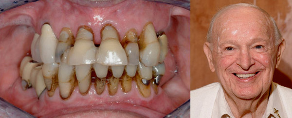 Smile Makeovers TeethToday Dental Implant Center