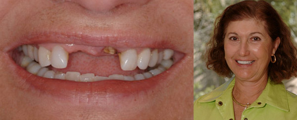 Smile Makeovers TeethToday Dental Implant Center