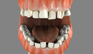 Mouth model with crowded teeth